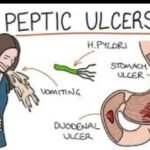 Package ya Kuanzia Kutibu Vidonda Vya Tumbo