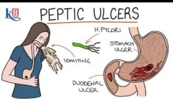 Package ya Kuanzia Kutibu Vidonda Vya Tumbo